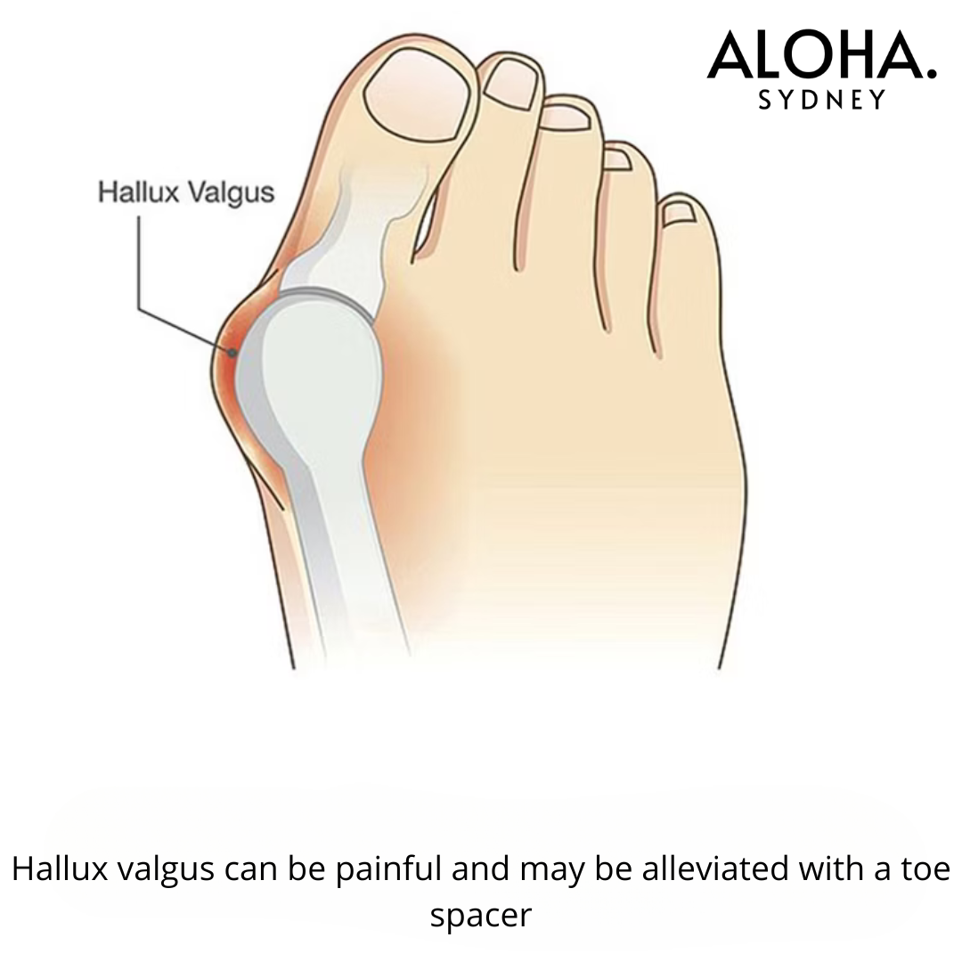 Hallux Valgus Support (2 Pieces)